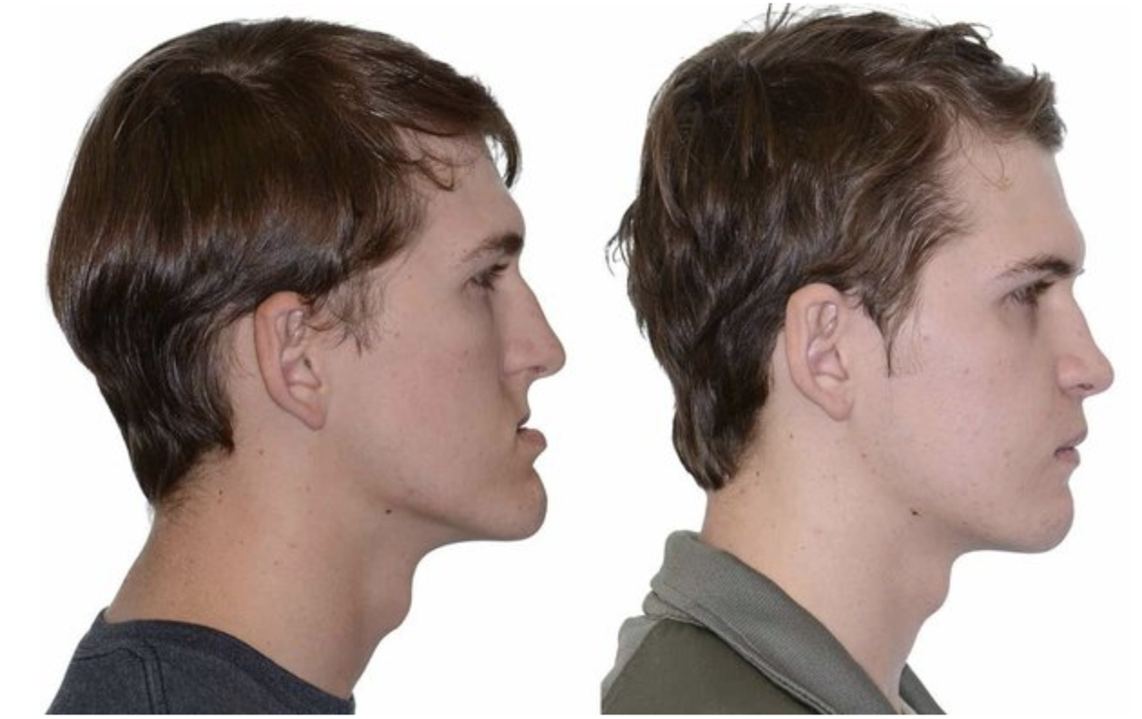 Recessed Maxilla How To Fix Before After Recessed Maxilla How To Fix Before After